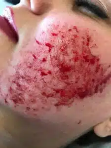 RF microneedling patient during treatment