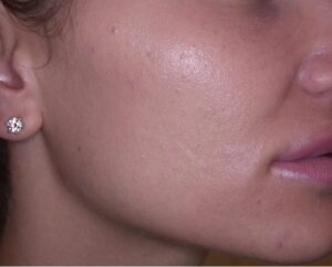 RF microneedling patient after treatment