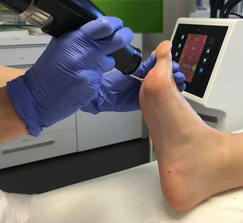 Removal of a wart from a patient's foot with a laser