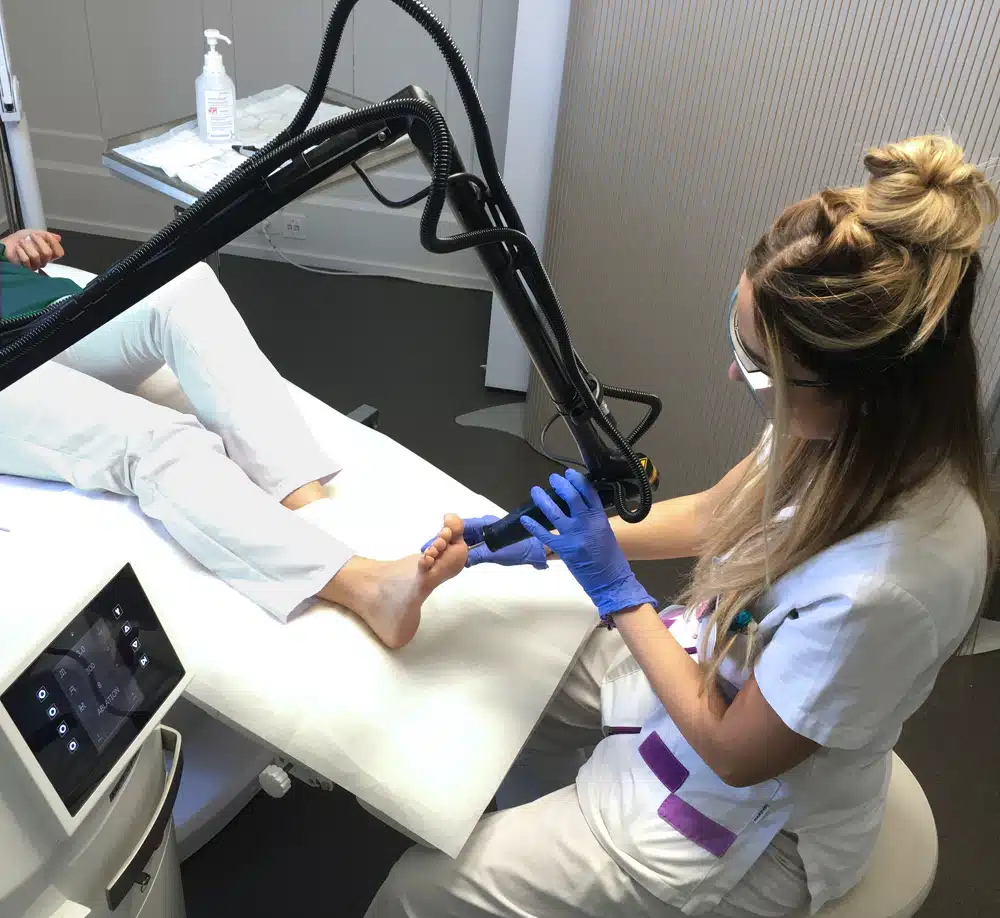 Warts are removed from one foot with a laser