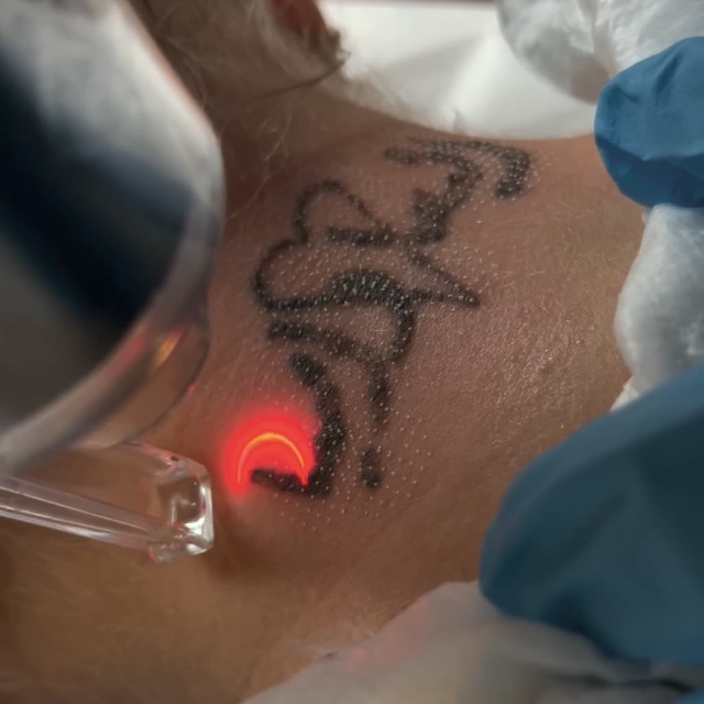 Tattoo Removal Los Angeles  Laser Tattoo Removers
