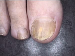 Infected nail before treatment