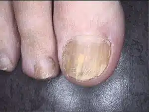 Infizierter Nagel vor der Behandlung