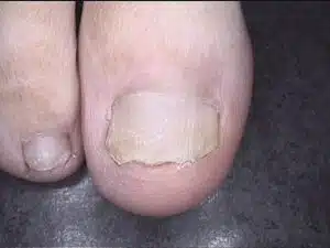 After treatment - The nail has not yet grown back completely.