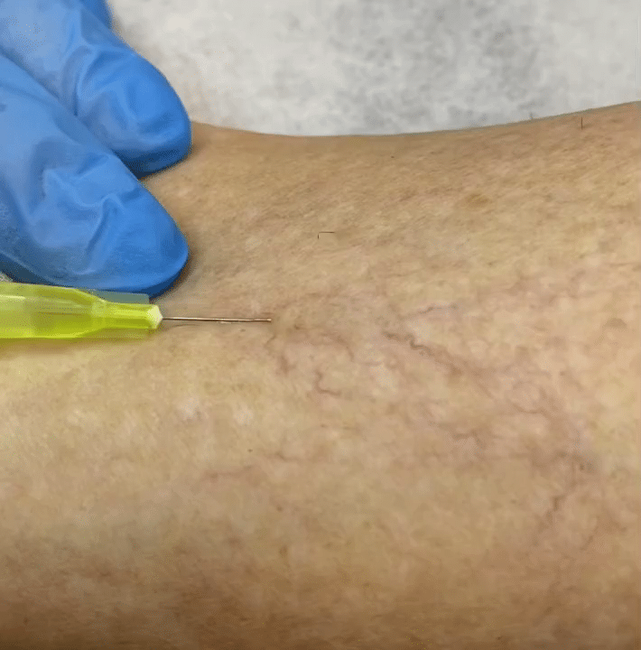 Treat spider veins in autumn