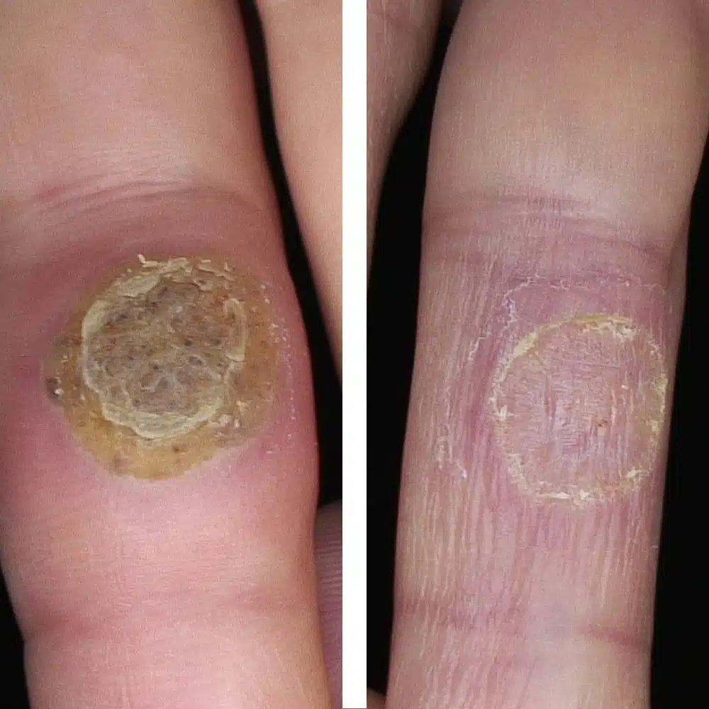 Comparison of patients before and after laser treatment of their wart