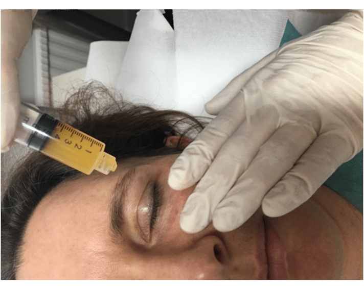 PRP injection into the scalp