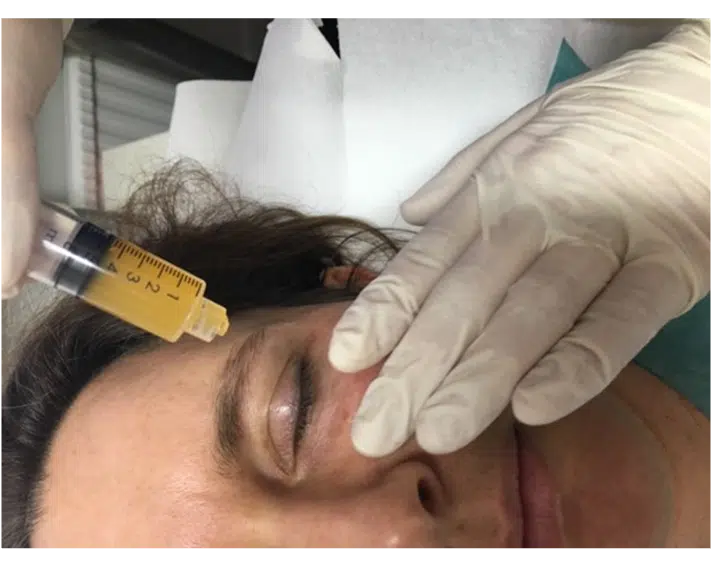 PRP Injektion in die Kopfhaut